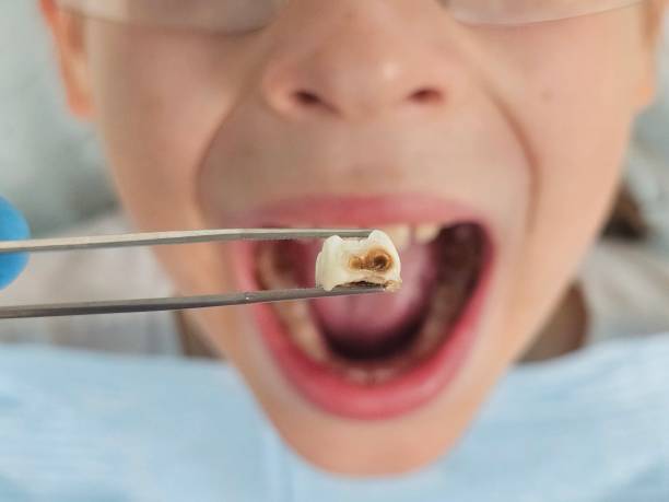 Best Same-Day Emergency Dentist in English, IN